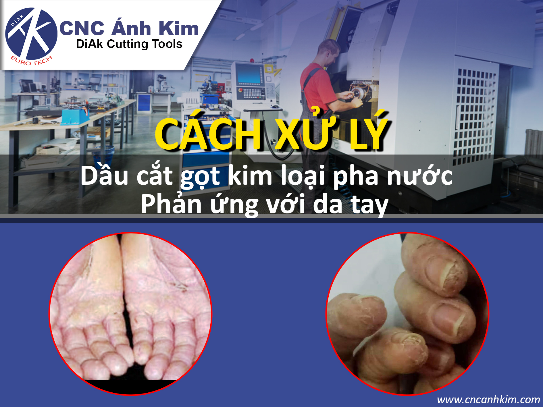 Cách xử lí khi da phản ứng với dầu cắt gọt kim loại pha nước