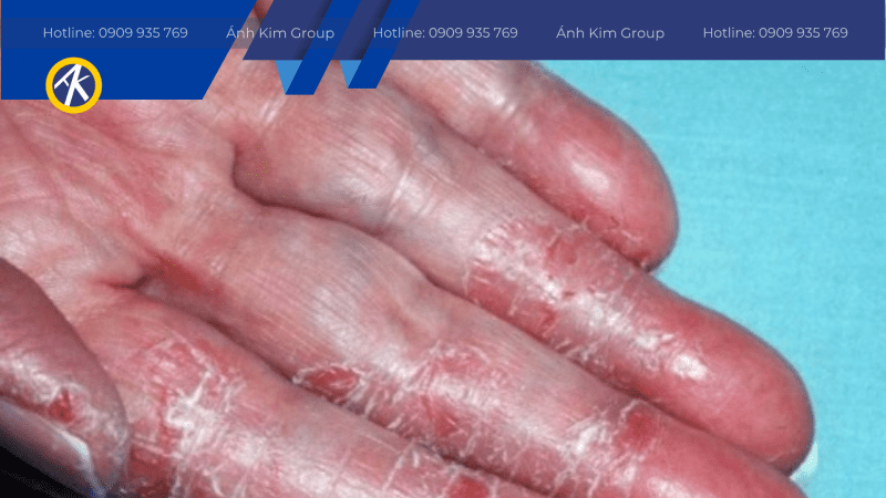 Viêm da tay khi sử dụng dầu cắt gọt